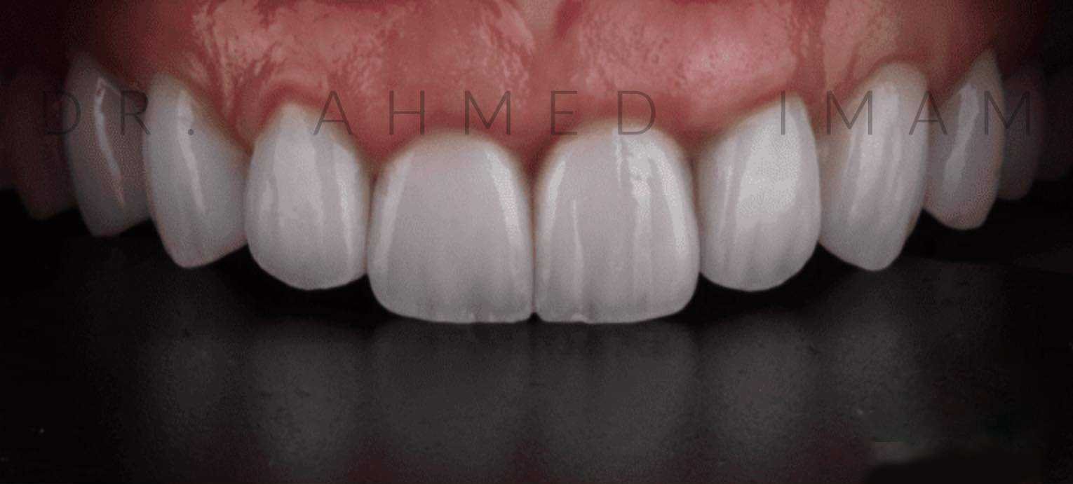 ابتسامة هوليوود